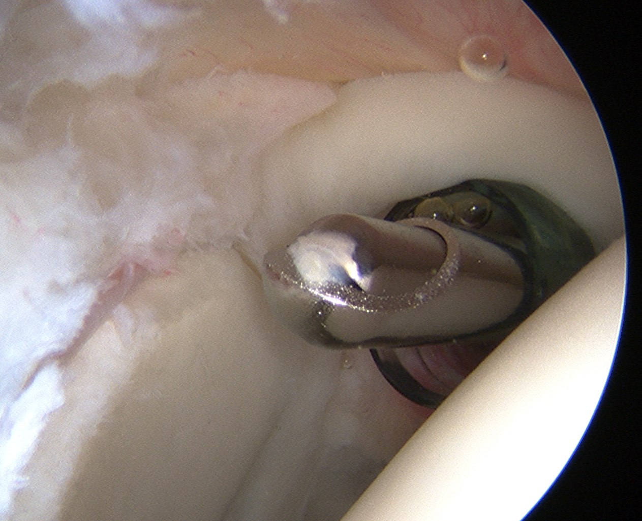 Arthroscopy Anterior Portal